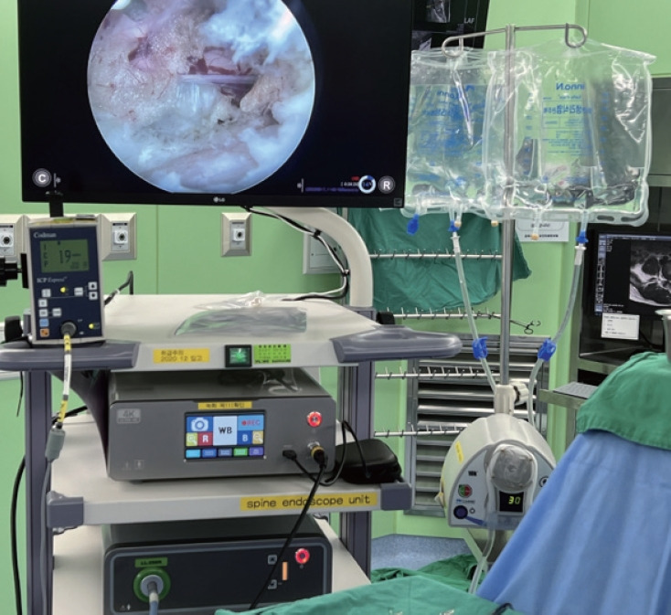 Real-Time Water Pressure Monitoring in Unilateral Biportal Endoscopic Spine Surgery.