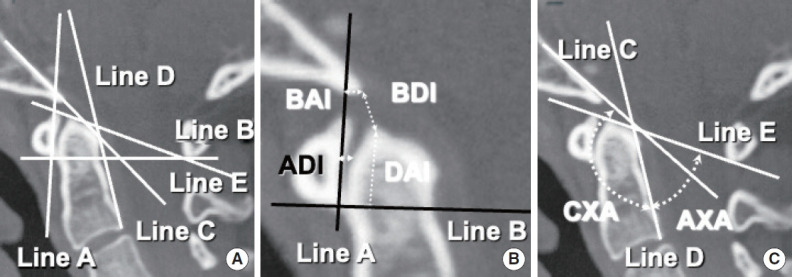 Chiari Malformation and Hindbrain Descent: Characterization and New Classification Based on Mechanism and Pathogenesis, and Surgical Management.