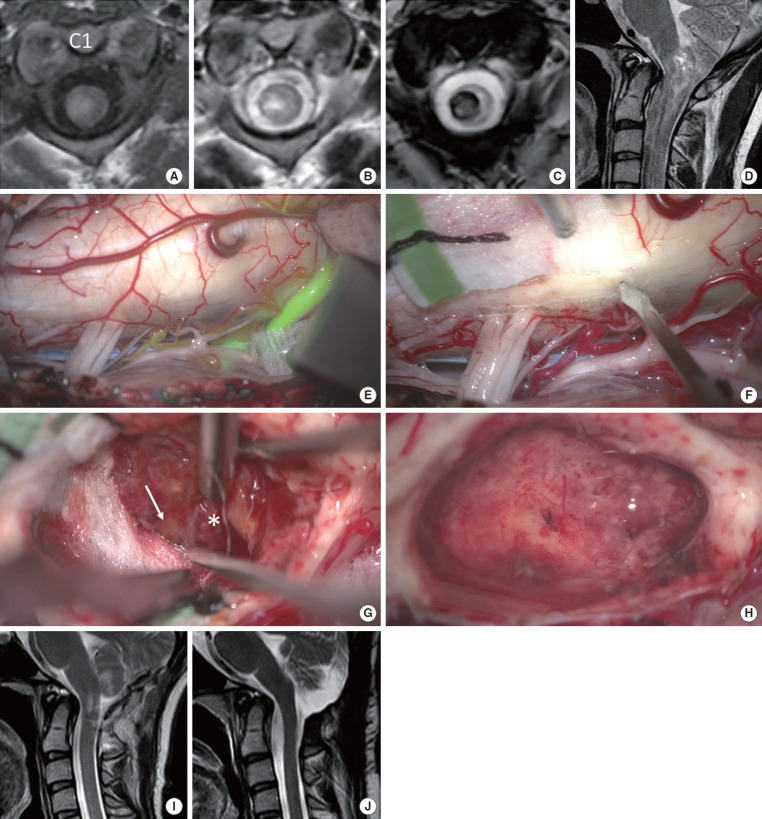Posterolateral Sulcus Approach for Intramedullary Hemorrhage Associated With Cavernous Malformation of High Cervical Spine: Operative Technique and Outcomes.