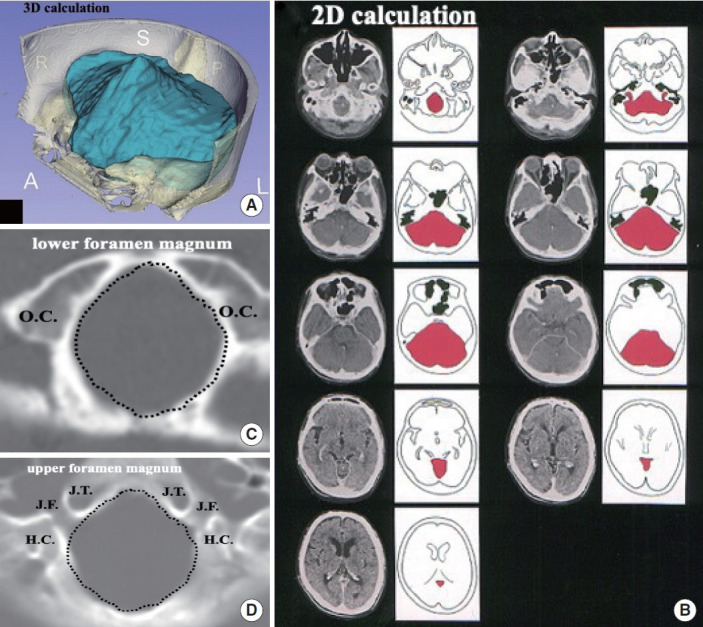 Chiari Malformation and Hindbrain Descent: Characterization and New Classification Based on Mechanism and Pathogenesis, and Surgical Management.