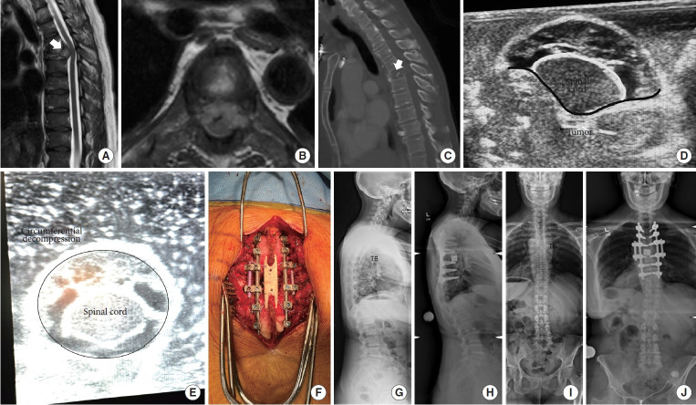 Advances in Metastatic Disease Spinal Oncology: Novel Technology Without Forgetting the Fundamentals of Surgical Treatment.