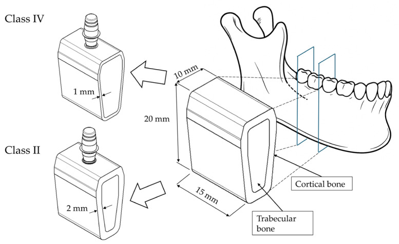 The Effect of Varying Abutment Heights on Stress Distribution in Different Bone Densities: A Finite Element Analysis Study.