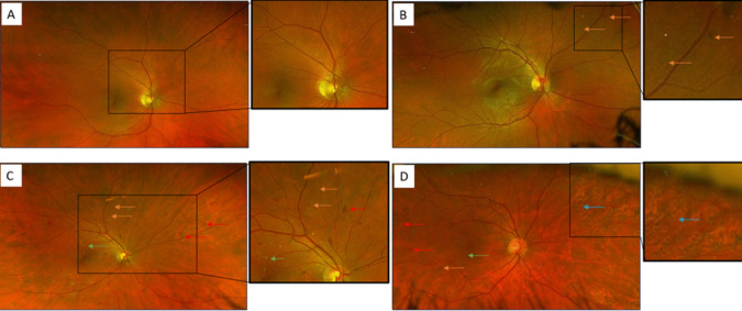How early can we detect diabetic retinopathy? A narrative review of imaging tools for structural assessment of the retina.