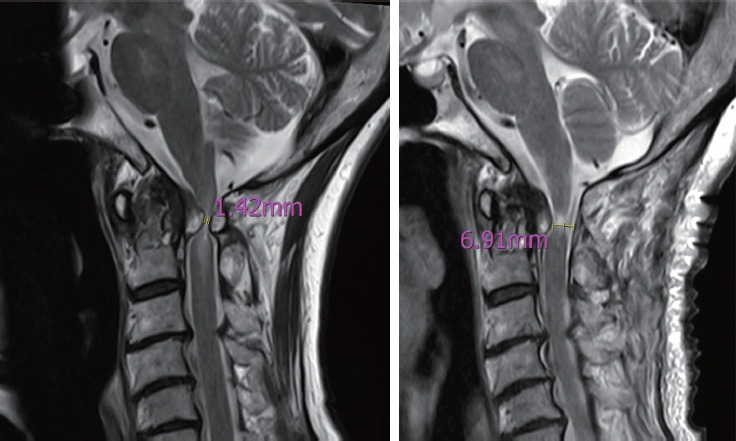 Retro-Odontoid Pseudotumor in Atlantoaxial Instability: Insights Into Presence, Subtypes, and Postoperative Regression.