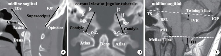 Chiari Malformation and Hindbrain Descent: Characterization and New Classification Based on Mechanism and Pathogenesis, and Surgical Management.