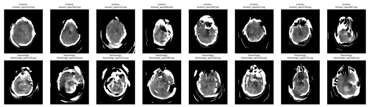 Brain Stroke Classification Using CT Scans with Transformer-Based Models and Explainable AI.