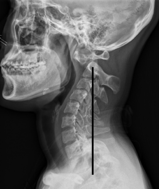 Prognostic Factors in Craniocervical Realignment for Crainovertebral Junction Kyphosis With Negative Cervical Imbalance: A Comprehensive Study.