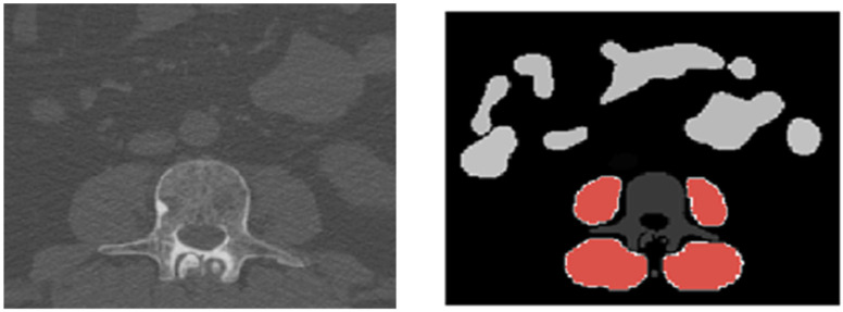 AI-Based 3D-Segmentation Quantifies Sarcopenia in Multiple Myeloma Patients.