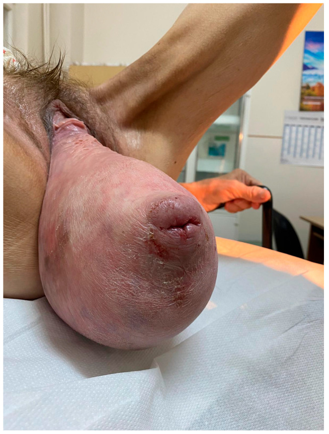 A Rare Case of Severe Pelvic Organ Prolapse with Massive Perineal Hernia in a Nulliparous Woman: A Case Report and Literature Review.