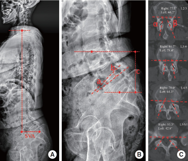 Association Between Facet Joint Orientation and Degenerative Spondylolisthesis: A Radiological Study of Double-Level Versus Single-Level Degenerative Spondylolisthesis.