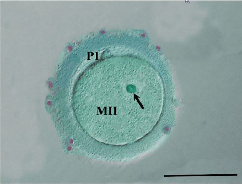 Application of Autologous Platelet-Rich Plasma-Supplemented Medium Promotes <i>In Vitro</i> Maturation of Human Germinal Vesicle Oocytes.