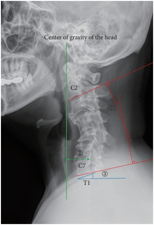 Long-term Outcomes of Multilevel Anterior Cervical Osteotomy and Posterior Instrumentation for OPLL-Induced Myelopathy With Cervical Kyphosis.