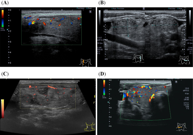 Thyrotoxicosis and Excess Iodine Due to Habitual Use of Polyvinylpyrrolidone Iodine While Gargling in an Iodine-sufficient Area.