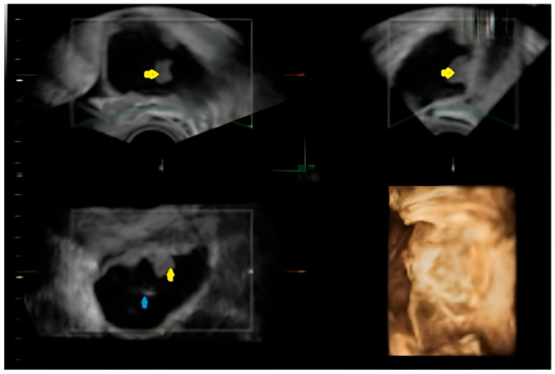 The Baffling Diagnosis of a Rare Case of Polypoid Endometriosis: Neoplasm Mimicking in a Young Pregnant Woman-A Case Report and Literature Review.