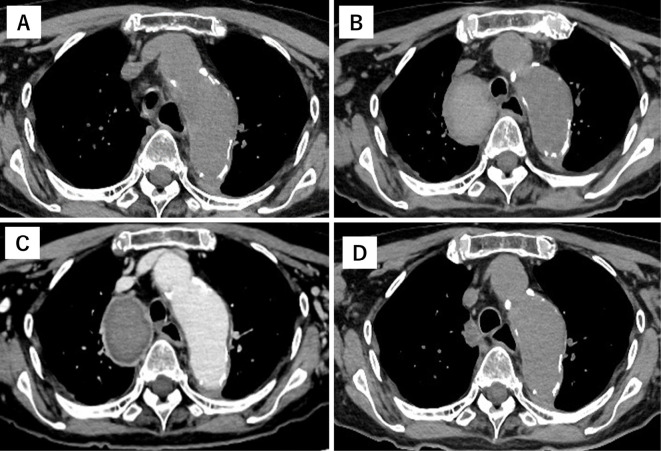 A Rapidly Enlarged Azygos Vein Aneurysm with Thrombosis.