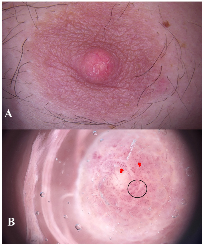 Squamous Metaplasia of Lactiferous Ducts (SMOLD) in a Male Patient: Clinical, Dermoscopic, and Histopathological Insights.
