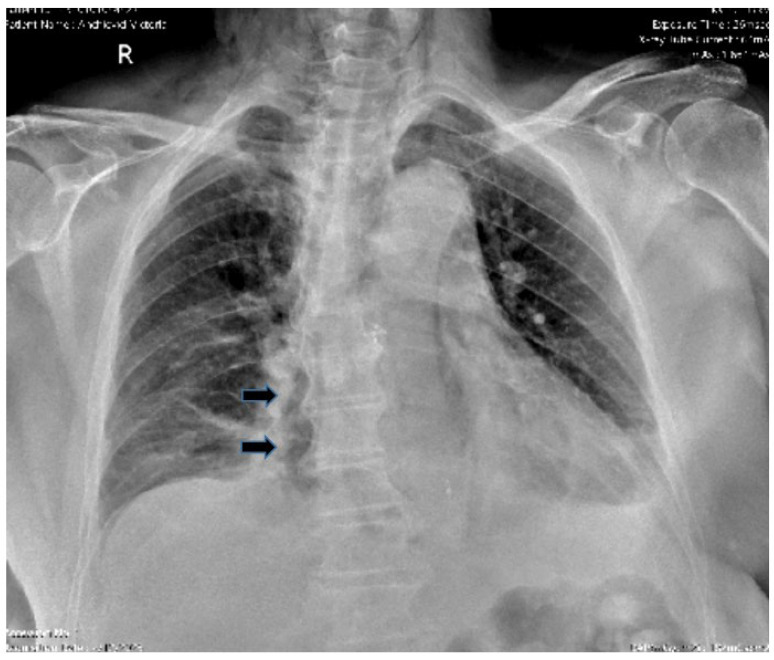 Boerhaave Syndrome-Narrative Review.