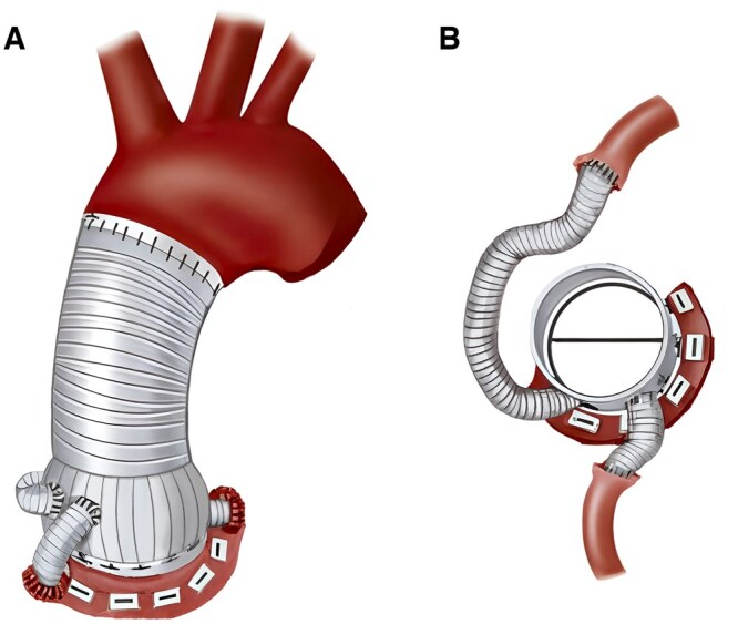 Outcomes of the modified Cabrol technique in aortic root replacement: Early and midterm experience.