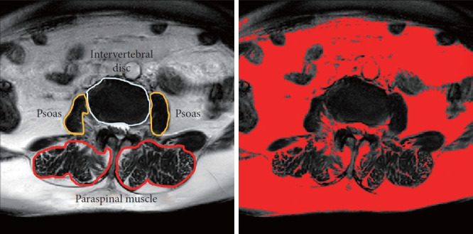 The Contribution of Paraspinal Sarcopenia on Sagittal Imbalance in Degenerative Kyphosis.