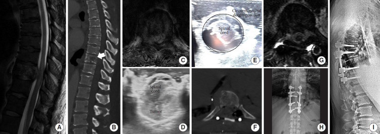 Advances in Metastatic Disease Spinal Oncology: Novel Technology Without Forgetting the Fundamentals of Surgical Treatment.