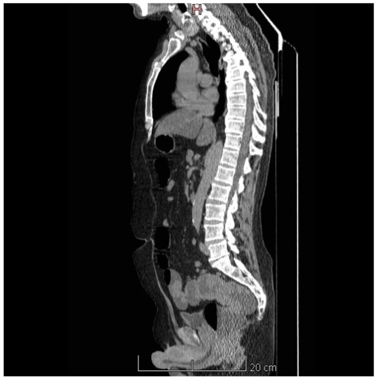 McKittrick-Wheelock Syndrome, a Rare Cause of Nonresponsive Persistent Dyselectrolytemia.