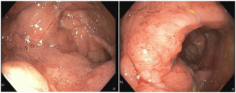 McKittrick-Wheelock Syndrome, a Rare Cause of Nonresponsive Persistent Dyselectrolytemia.
