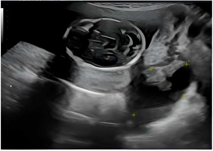 The Baffling Diagnosis of a Rare Case of Polypoid Endometriosis: Neoplasm Mimicking in a Young Pregnant Woman-A Case Report and Literature Review.