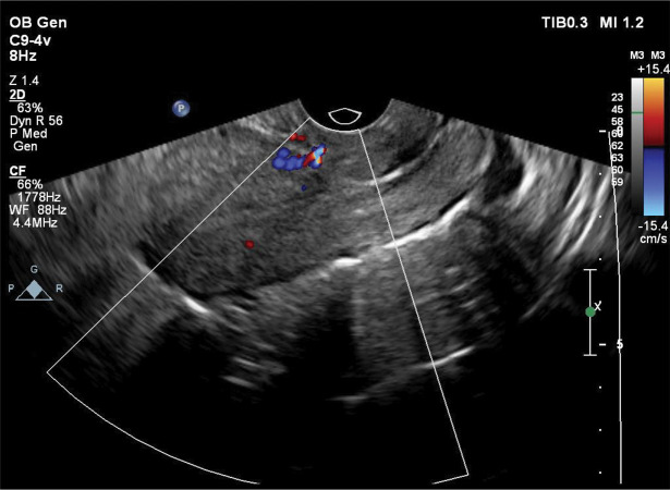 Could Hypogastric Artery Ligation Be An Alternative To Artery Embolization For Managing Vaginal Bleeding? A Case Report.