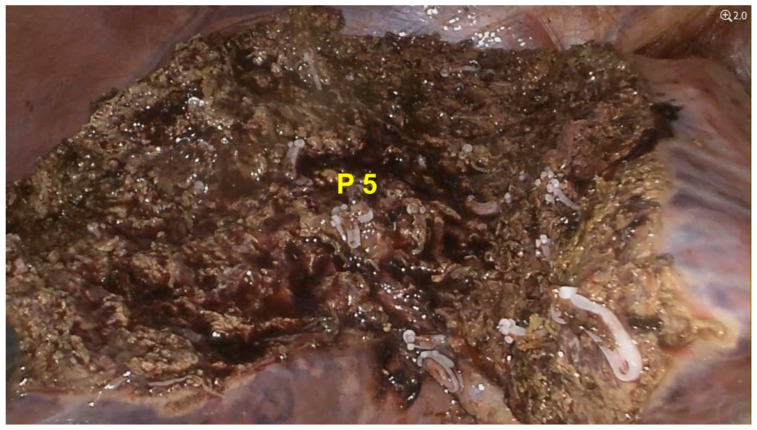 Hepatic Focal Lesion Suspicious for Hepatocellular Carcinoma in a Patient with a History of Post-Traumatic Splenectomy: The Challenge of Differential Diagnosis with Intrahepatic Splenosis-Literature Review and Case Report.