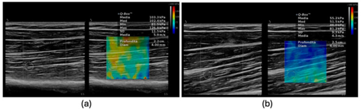 Echoes of Muscle Aging: The Emerging Role of Shear Wave Elastography in Sarcopenia Diagnosis.