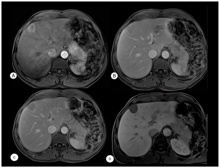 Hepatic Focal Lesion Suspicious for Hepatocellular Carcinoma in a Patient with a History of Post-Traumatic Splenectomy: The Challenge of Differential Diagnosis with Intrahepatic Splenosis-Literature Review and Case Report.