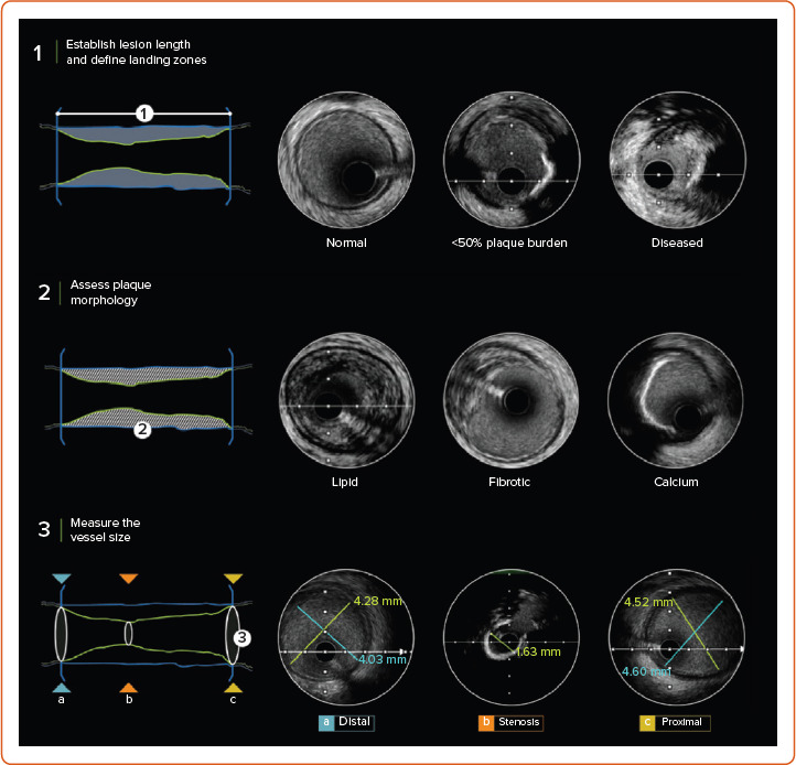 Workflow-based Framework to Aid with High-Definition Intravascular Ultrasound-Optimised Coronary Stenting: Introducing IVUS 123 Essentials.