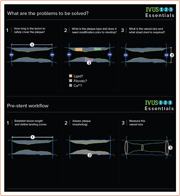 Workflow-based Framework to Aid with High-Definition Intravascular Ultrasound-Optimised Coronary Stenting: Introducing IVUS 123 Essentials.