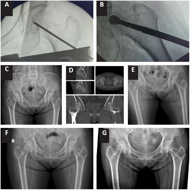 A retrospective comparison of hyperbaric oxygen and core decompression for mild to moderate avascular necrosis of the femoral head.