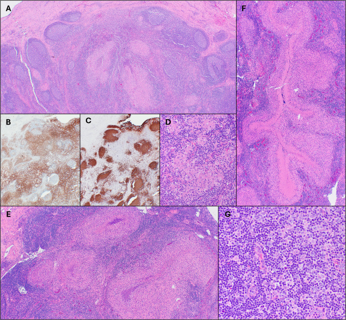 Histopathologic findings of tularemia lymphadenitis.