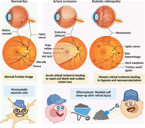 Efferocytosis and retinal clean-up: Role of histone deacetylase 3 in ischemic retinopathy.