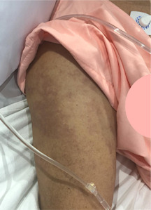 Decompression sickness type II and patent foramen ovale: when a common congenital anomaly becomes a life-threatening risk.