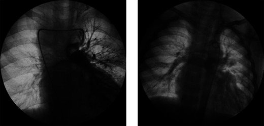 Utility of inhaled nitric oxide for pulmonary hypertension in cyanotic congenital heart disease: a cohort study with propensity score matching.