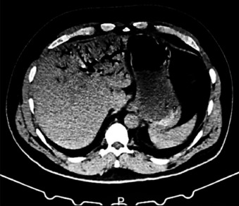 Decompression sickness type II and patent foramen ovale: when a common congenital anomaly becomes a life-threatening risk.