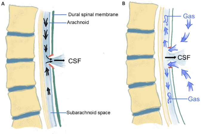 Gas-induced spinal cord compression: mechanisms, diagnosis, and treatment of intraspinous pneumorrhachis.