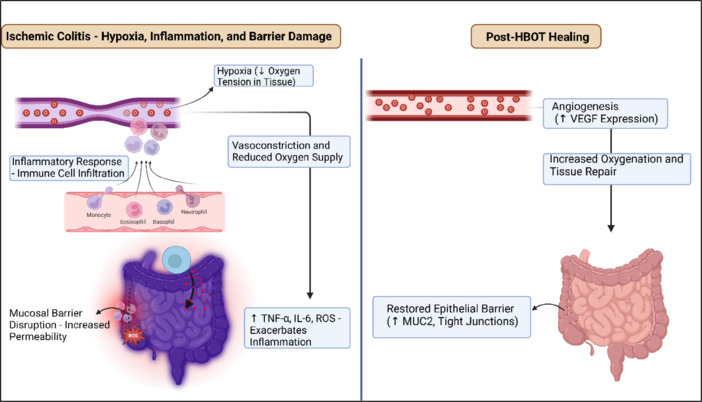 Oxygen therapy in ischemic colitis.