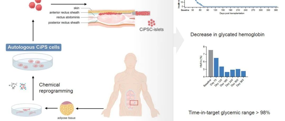 Cell丨北京大学邓宏魁/沈中阳/王树森团队合作报道首例移植化学重编程多能干细胞制备的胰岛实现1型糖尿病患者临床功能性治愈