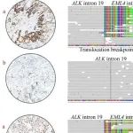 颠覆传统观点：ALK VAF可能无法准确预测非小细胞肺癌靶向治疗效果｜FMD