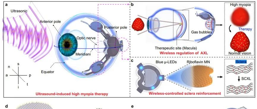 文献分享 | Nat.Commun. | 一种用于高度近视治疗的无线无需电池供应的眼部调制贴片