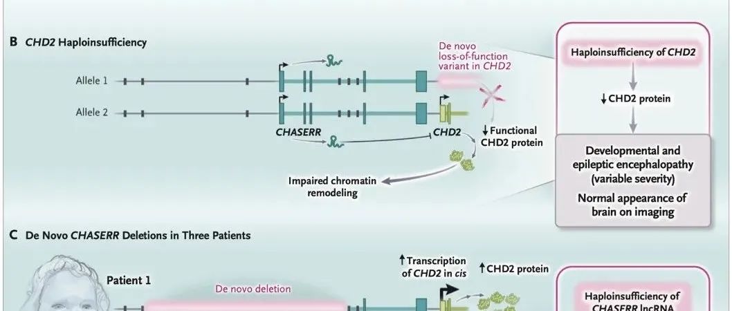 【科技前沿】NEJM | 陈玲玲评述，首次证实lncRNA单拷贝缺失引起人类严重大脑疾病