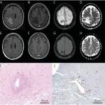 Neurology：瘤样血管炎