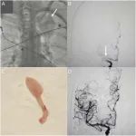 Neurology：肿瘤栓子