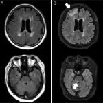 Neurology：PML与高灌注