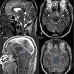 Neuroradiology：脊髓痴呆，一种可治疗的痴呆