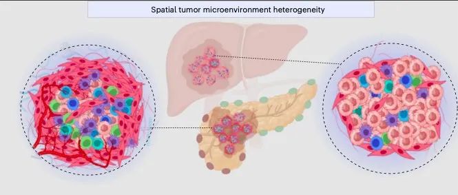 文献分享 ｜Nature Genetics｜原发性和转移性胰腺癌的空间转录组分析突出肿瘤微环境的异质性